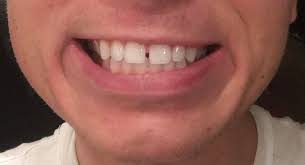 However, the duration and outcome depend on the cause, dental structure, age, gap size, and expectation. Best Way To Fix This Tooth Gap Invisalign Veneers Bonding Teeth