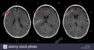 Ct Scan Of The Brain Of A 6 Month Old Child Showing A Subdural Hematoma Stock Photo Alamy