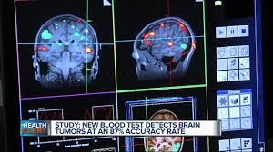 Maybe you would like to learn more about one of these? New Blood Test Detects Brain Tumors With 87 Accuracy