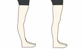 However, anyone can suffer from a. Fixing Hyperextended Knee Posture Pilates Foundation