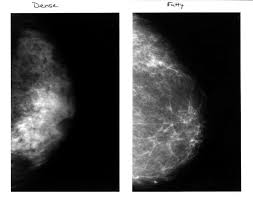 So does a possible tumor. How Often Should You Get A Mammogram It Depends On Whether You Have Dense Breast Tissue Experts Say Los Angeles Times