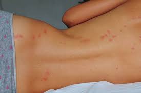 Image result for bedbugs bites