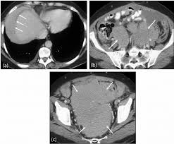 Get a free evaluation now! Malignant Peritoneal Mesothelioma A Contrast Enhanced Axial Ct Of Download Scientific Diagram