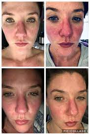What is the best remedy for a minor burn? Will The Burning Ever Stop Rosacea