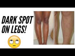 Blemishes occur mainly due to the excessive dead skin cells and oil production, leading to pore blockage. How To Get Rid Of Dark Spots Hyperpigmentation On Legs Part 1 Skincare Routine Acne Tretinoin Youtube