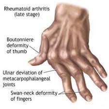 8 Natural Remedies For Arthritis In Hands Worlds News Arthritis Hands Rheumatoid Arthritis Hands Rheumatoid Arthritis Diet