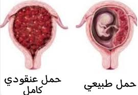 الحمل_العنقودي 🔴 الحمل بعد حدوث الحمل العنقودي لا يؤثر الحمل العنقودي على الفرصة في انجاب طفل آخر ، ومع ذلك بعد حدوث الحمل العنقودي يجب ان يتم استخدام مانع للحمل حتى تنتهى