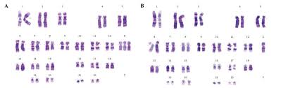 Concurrent Insulinoma With Mosaic Turner Syndrome A Case Report