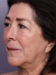 HALO Gallery Before & After 06