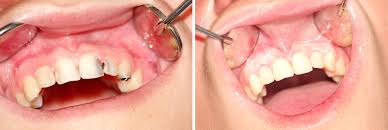 Fillings this is the most common way dentists fix cavities, even on front teeth. Tooth Cavity Filling Innovative Smile Dental Clinic