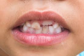 Chalky Teeth In Children Molar Hypomineralisation Symptoms
