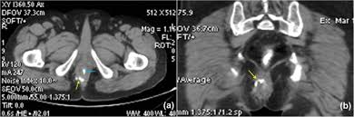 Their main function is contractibility. Current Imaging Techniques For Evaluation Of Fistula In Ano A Review Egyptian Journal Of Radiology And Nuclear Medicine Full Text