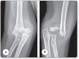 Humerus nail manufacturers and suppliers. Jaypeedigital Ebook Reader