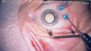 An Eye Lens Replacement Surgery In Full Detail Stock Footage Replacement Surgery Eye Lens Lens Surgery Replacement