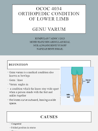 Image result for Genu Varum