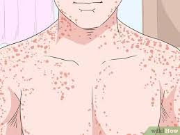 Origins, transmission, pathophysiology, signs & symptoms, diagnosis, treatmentin this lesson, we discuss where this virus was first. How To Recognize Marburg Hemorrhagic Fever Symptoms 13 Steps