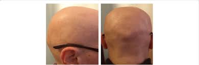 It is the most severe form of alopecia areata. Alopecia Universalis Affected Male Download Scientific Diagram