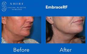 Maybe you would like to learn more about one of these? Embracerf Before After Shire Facial Plastic Surgery