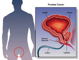 When prostate cancer spreads from its original place to another part of the body, the new tumor has the same kind of abnormal cells and the same to understand prostate cancer, it helps to know how the prostate normally works. Prostate Cancer What You Need To Know Patient Care