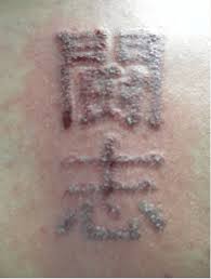 After you have undergone your tattoo removal procedure, it is important but also helpful for your own sake to be aware of what you can expect during the healing process. Speeding Up Laser Tattoo Removal Healing Inkfree Md Houston Tx