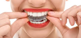 Smileadvantage $1635 $1185 order now. How Much Does Invisalign Cost And Is It Worth It Modern Orthodontics Blog