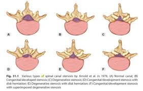 Central canal of spinal cord (canalis centralis medullae spinalis); Lumbar Spinal Stenosis Physiopedia