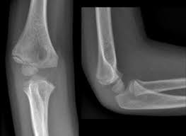 Image result for Lateral Condyle Fracture