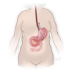 Pin On Weight Loss Surgery Procedures