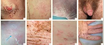 Image result for scabies in the groin area