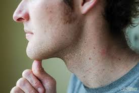 Treat Temporomandibular Joint Disorder Tmd With Jaw Exercises Healing Jaw Pain Jaw Exercises Natural Headache Remedies