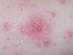 Watch this video to learn about the symptoms. Blisters And Pustules In Neonates Dermnet Nz