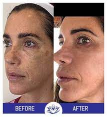 See below some amazing results from our treatments at pacific coast aesthetics. Before And After Gallery Pacific Coast Aesthetics In Aptos Ca