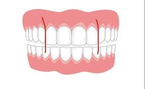 Fixing gap teeth can be painful and expensive. How Does My Orthodontist Fix Gaps In Between These Teeth That I Marked They Can T Just Push The Front 4 Back Because The Top 4 Go Right Over The Bottom Row So