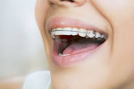 Are Braces Really Worth It? - Youtube
