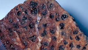 Nevroendokrin (net) kreft er et samlebegrep på en rekke hormonproduserende kreftsvulster som i hovedsak blir funnet i tarmsystemet eller i lungene, men kan også forekomme i mange andre av. Biologi Livsstilssykdommer Respirasjon Ndla