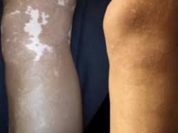 The energy from the laser breaks down the a quicker alternative for big tattoos is skin grafting. Skin Transplant Surgery Benefits Vitiligo Patients Lasermed Laser Hair Removal Laser Tattoo Removal Laser Clinic Cape Town Skin Rejuvenation Fractional Resurfacing Laser Chemical Peels