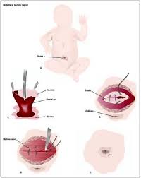 Maybe you would like to learn more about one of these? Umbilical Hernia Repair Procedure Recovery Blood Pain Complications Adults Time Infection