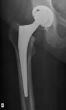 Acetabular Cup - an overview | ScienceDirect Topics