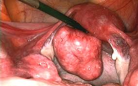 Myom rahim kasını meydana getiren hücrelerden gelişen büyümedir. Starke Schmerzen Durch Myome Oder Endometriose Medmix