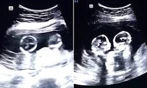 Identical Twins Are Spotted Fighting In Their Mother S Womb During An Ultrasound Scan Daily Mail Online Family business because the movie has not released yet (mar 26, 2021). identical twins are spotted fighting