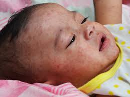 While the covid vaccine has been proven to be safe, it doesn't come without warnings: Measles In Babies Babycentre Uk