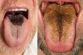 Image result for black hairy tongue symptoms