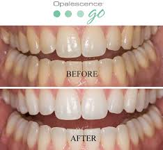 No matter which treatment you're booked in for, we work with you to personalise it, allowing you to achieve an. Teeth Whitening In Nairobi Kenya Dentist Nairobi Kenya Tender Care Dental Tender Care Dental