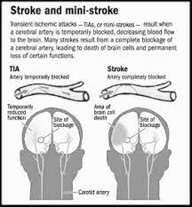 Mini Strokes Can Be A Warning A Stroke May Follow New Orleans Multicultural News Source The Louisiana Weekly