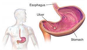 Ulcers After Wls: Causes, Symptoms And Treatments