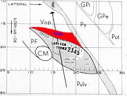 Image result for Thalamotomy