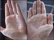 Desquamation — (n.) the separation or shedding of the cuticle or epidermis in the form of flakes. ØªÙˆØ³Ù ÙˆÙŠÙƒÙŠØ¨ÙŠØ¯ÙŠØ§