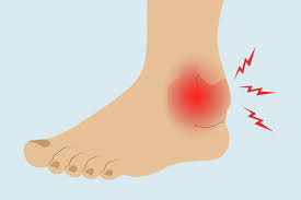A broken ankle may also involve damage to the ligaments. Arthritis In The Ankle Treatments Exercises And Home Remedies