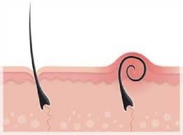 This is solely the hair growing under the top layer of the epidermis. Ingrown Hairs Do Not Have To Be A Problem Wembley Clinic