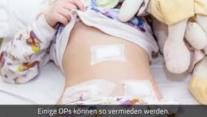 Blinddarm Entzundung Eine Op Ist Nicht Immer Sofort Notwendig